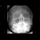 Fracture of the left zygomaticomaxillary complex (ZMK), hemosinus: X-ray - Plain radiograph